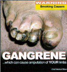 Jamaica 2013 Health effects vascular system - diseased foot, gangrene (back)
